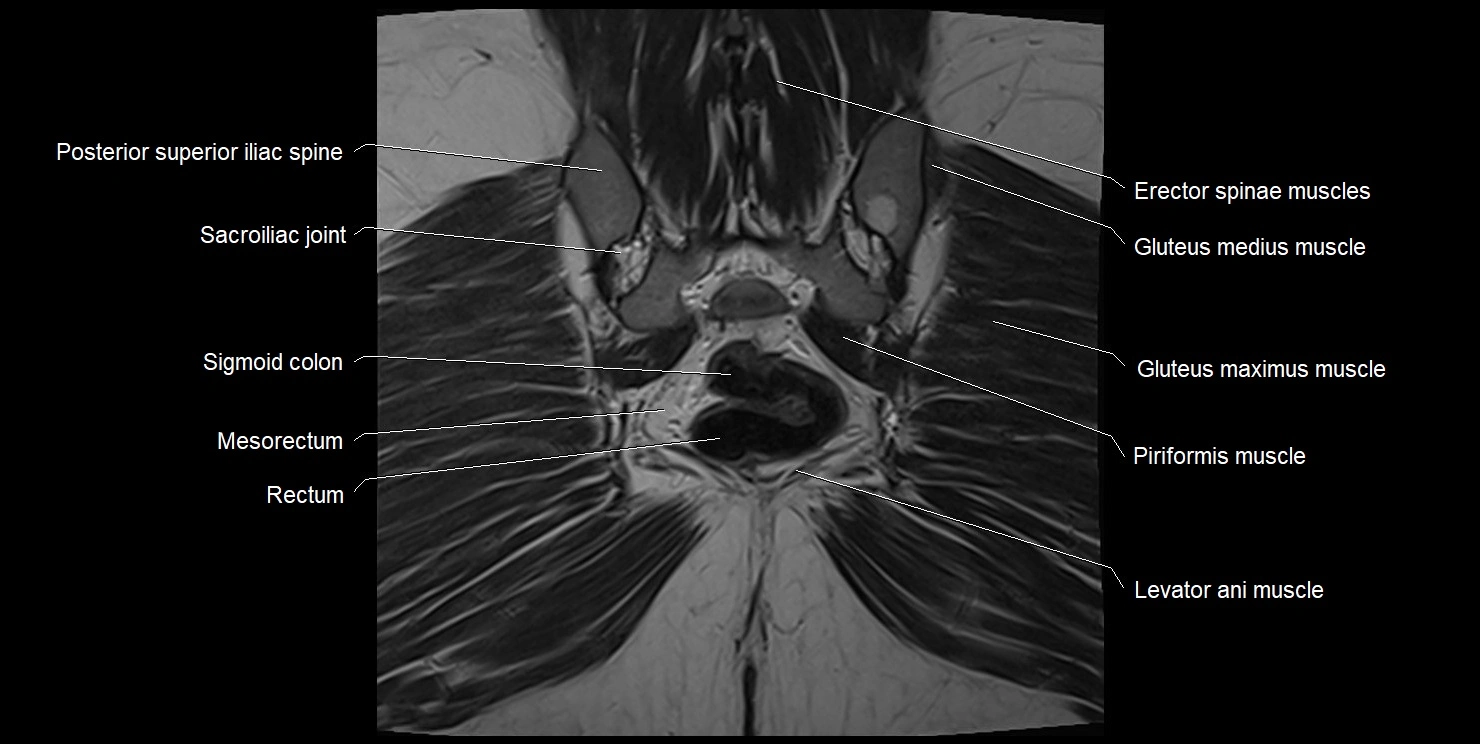 female pelvis coronal cross sectional anatomy image 32.webp